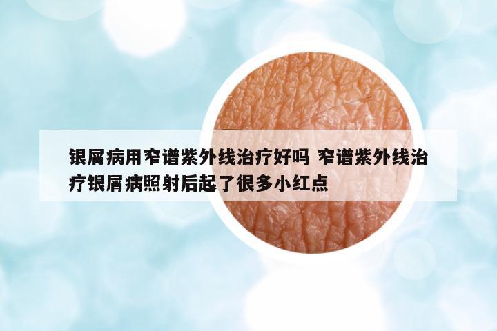 銀屑病用窄譜紫外線治療好嗎 窄譜紫外線治療銀屑病照射后起了很多小紅點