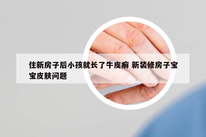 住新房子后小孩就長(zhǎng)了牛皮癬 新裝修房子寶寶皮膚問題