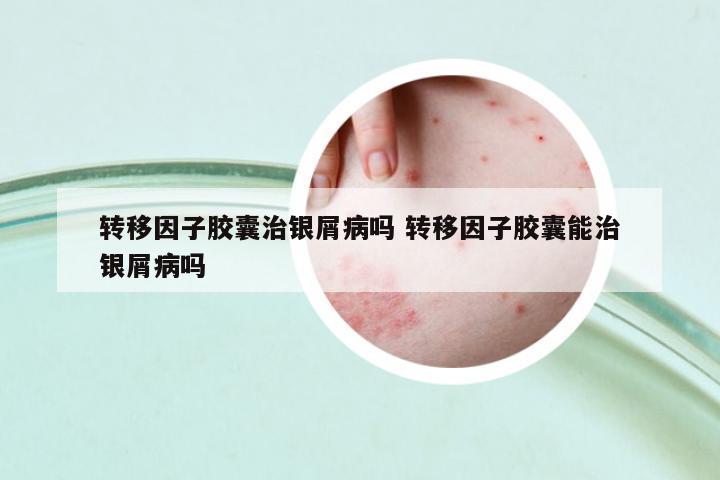 轉(zhuǎn)移因子膠囊治銀屑病嗎 轉(zhuǎn)移因子膠囊能治銀屑病嗎