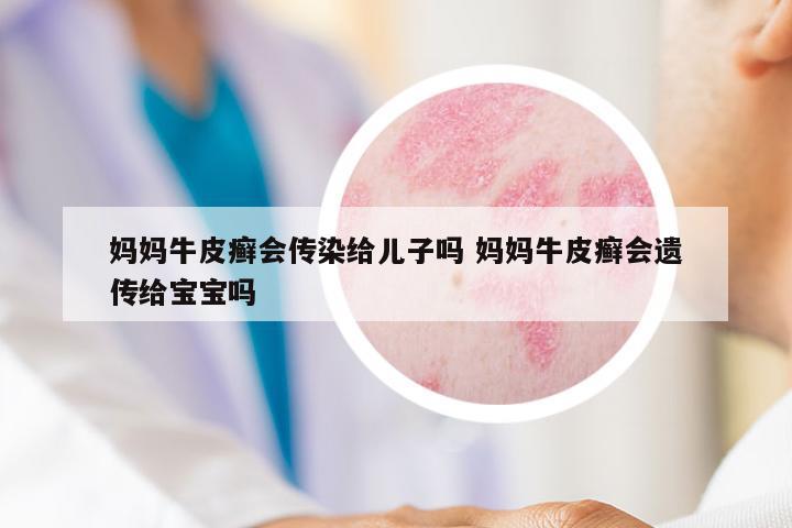 媽媽牛皮癬會(huì)傳染給兒子嗎 媽媽牛皮癬會(huì)遺傳給寶寶嗎