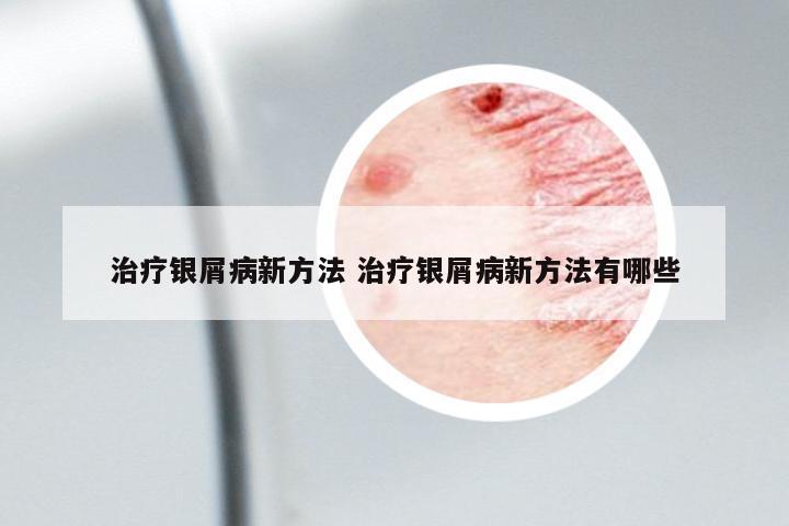 治療銀屑病新方法 治療銀屑病新方法有哪些