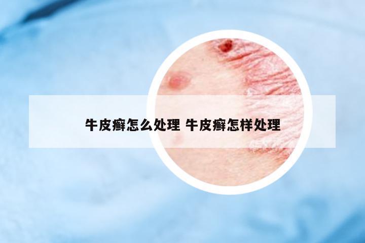 牛皮癬怎么處理 牛皮癬怎樣處理