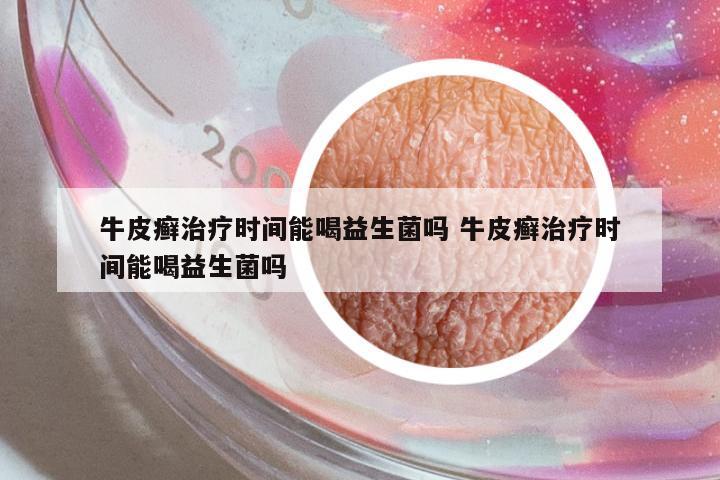 牛皮癬治療時間能喝益生菌嗎 牛皮癬治療時間能喝益生菌嗎