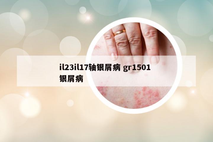 il23il17軸銀屑病 gr1501 銀屑病