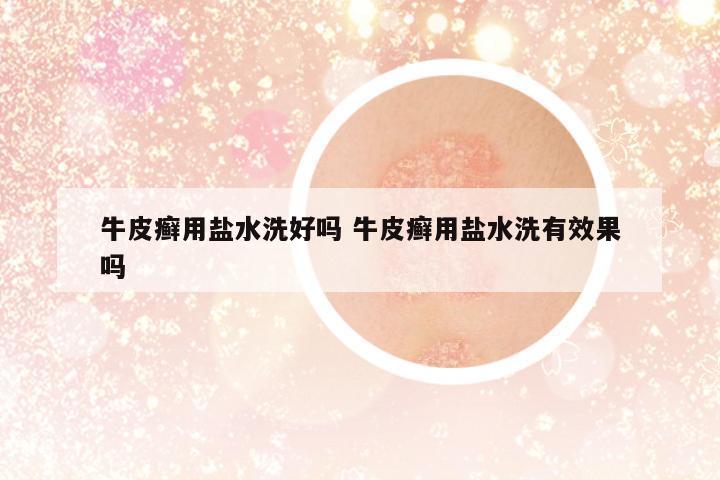 牛皮癬用鹽水洗好嗎 牛皮癬用鹽水洗有效果嗎