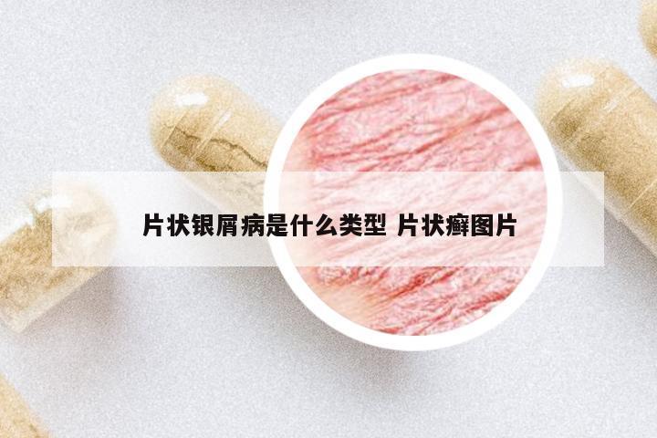 片狀銀屑病是什么類型 片狀癬圖片