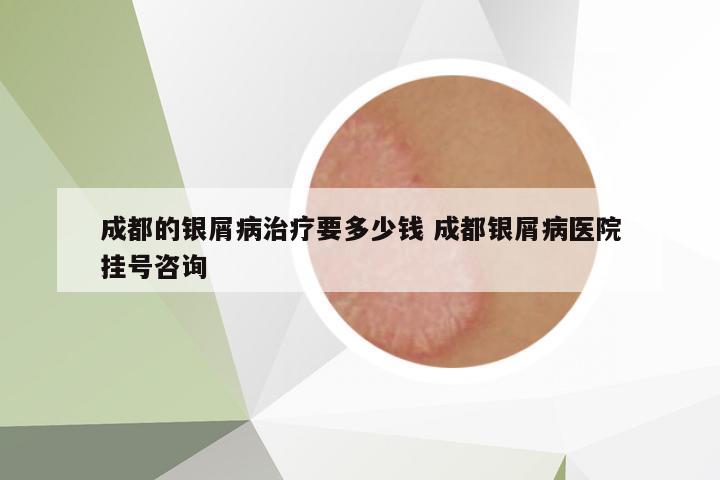 成都的銀屑病治療要多少錢 成都銀屑病醫(yī)院掛號(hào)咨詢