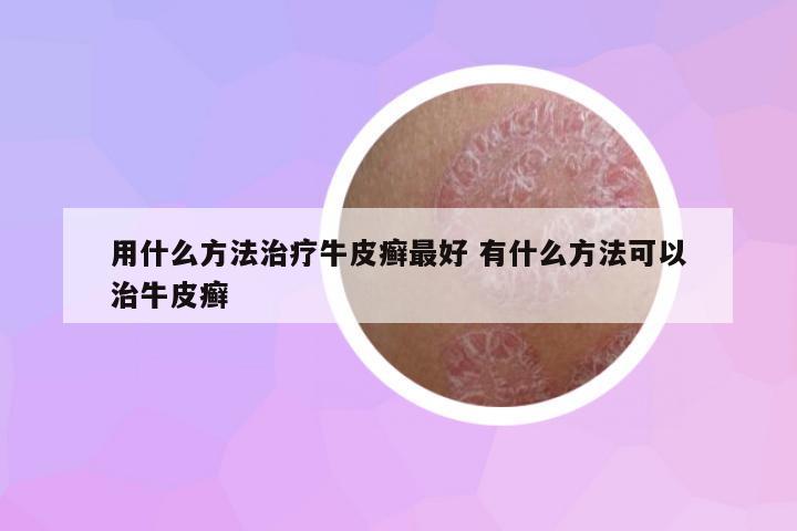 用什么方法治療牛皮癬最好 有什么方法可以治牛皮癬