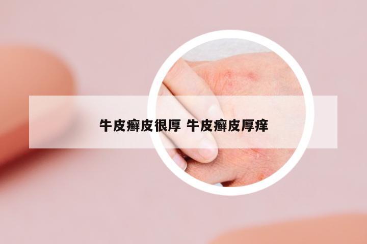 牛皮癬皮很厚 牛皮癬皮厚癢
