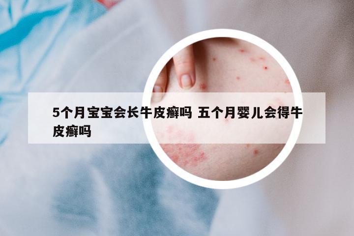 5個月寶寶會長牛皮癬嗎 五個月嬰兒會得牛皮癬嗎
