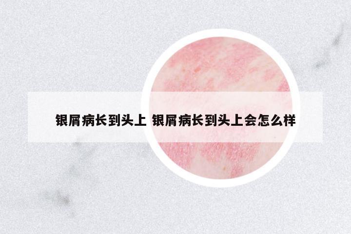 銀屑病長(zhǎng)到頭上 銀屑病長(zhǎng)到頭上會(huì)怎么樣