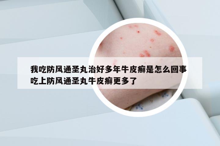 我吃防風(fēng)通圣丸治好多年牛皮癬是怎么回事 吃上防風(fēng)通圣丸牛皮癬更多了