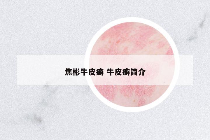 焦彬牛皮癬 牛皮癬簡介