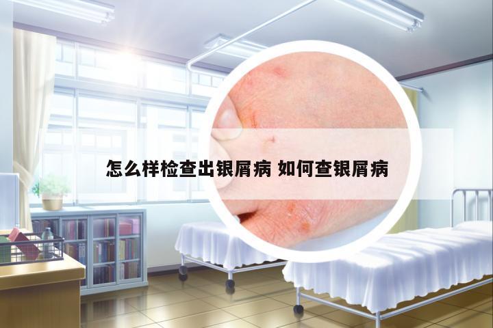 怎么樣檢查出銀屑病 如何查銀屑病