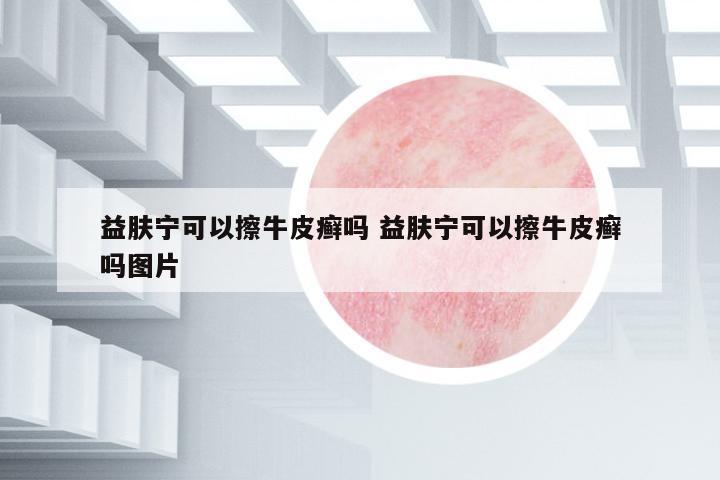 益膚寧可以擦牛皮癬嗎 益膚寧可以擦牛皮癬嗎圖片