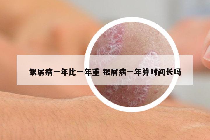 銀屑病一年比一年重 銀屑病一年算時間長嗎