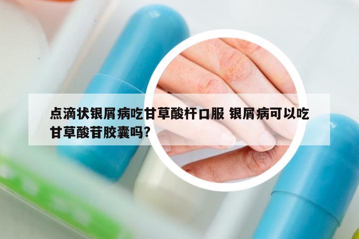 點(diǎn)滴狀銀屑病吃甘草酸桿口服 銀屑病可以吃甘草酸苷膠囊嗎?