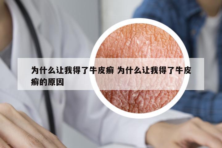 為什么讓我得了牛皮癬 為什么讓我得了牛皮癬的原因