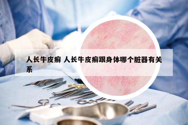 人長牛皮癬 人長牛皮癬跟身體哪個臟器有關(guān)系