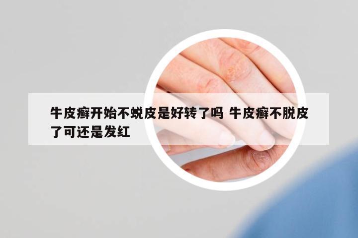 牛皮癬開(kāi)始不蛻皮是好轉(zhuǎn)了嗎 牛皮癬不脫皮了可還是發(fā)紅