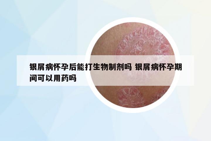 銀屑病懷孕后能打生物制劑嗎 銀屑病懷孕期間可以用藥嗎