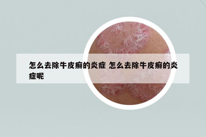 怎么去除牛皮癬的炎癥 怎么去除牛皮癬的炎癥呢