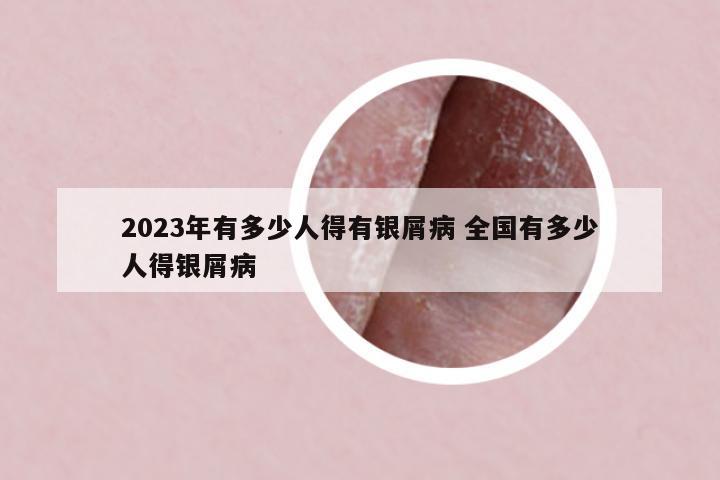 2023年有多少人得有銀屑病 全國有多少人得銀屑病