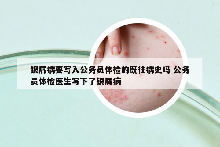 銀屑病要寫入公務(wù)員體檢的既往病史嗎 公務(wù)員體檢醫(yī)生寫下了銀屑病