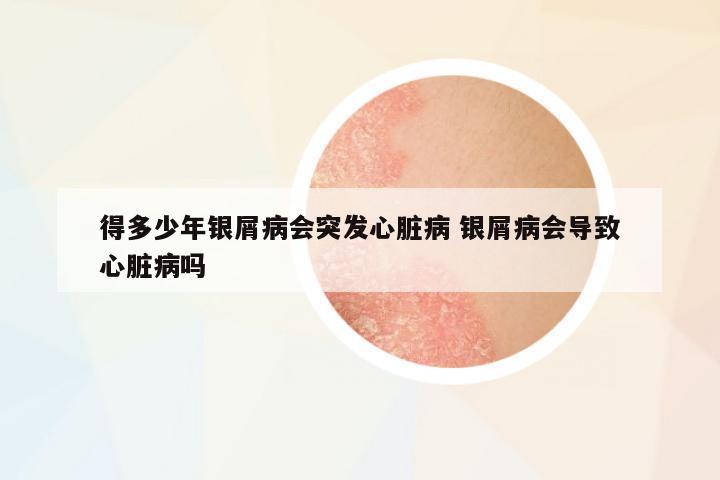 得多少年銀屑病會突發(fā)心臟病 銀屑病會導致心臟病嗎