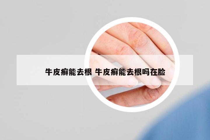 牛皮癬能去根 牛皮癬能去根嗎在臉