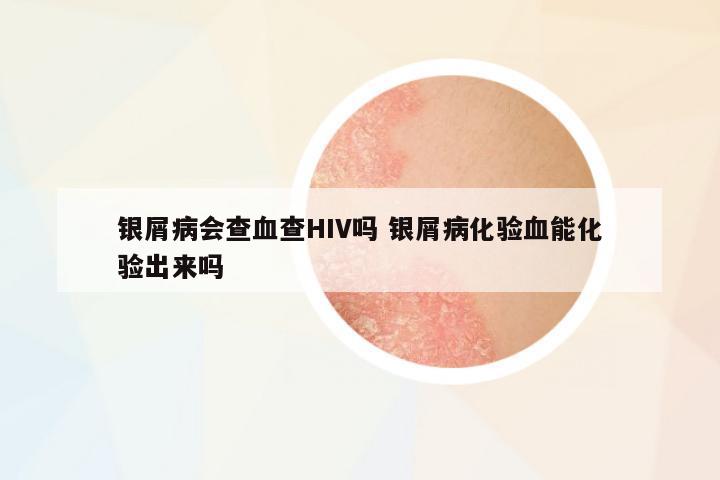 銀屑病會查血查HIV嗎 銀屑病化驗(yàn)血能化驗(yàn)出來嗎