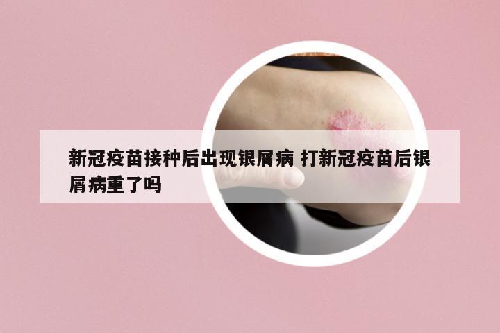 新冠疫苗接種后出現(xiàn)銀屑病 打新冠疫苗后銀屑病重了嗎