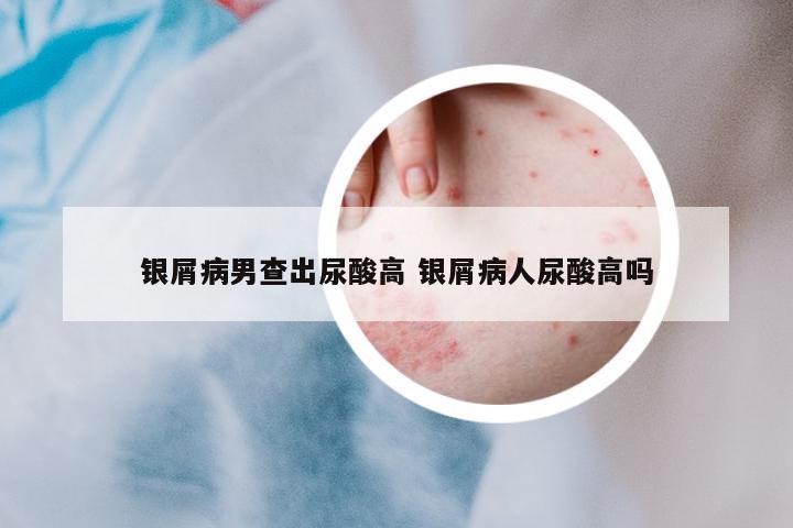 銀屑病男查出尿酸高 銀屑病人尿酸高嗎