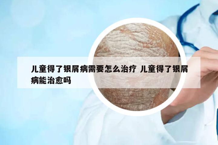 兒童得了銀屑病需要怎么治療 兒童得了銀屑病能治愈嗎