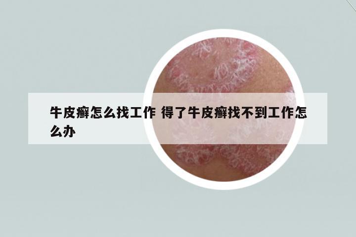 牛皮癬怎么找工作 得了牛皮癬找不到工作怎么辦