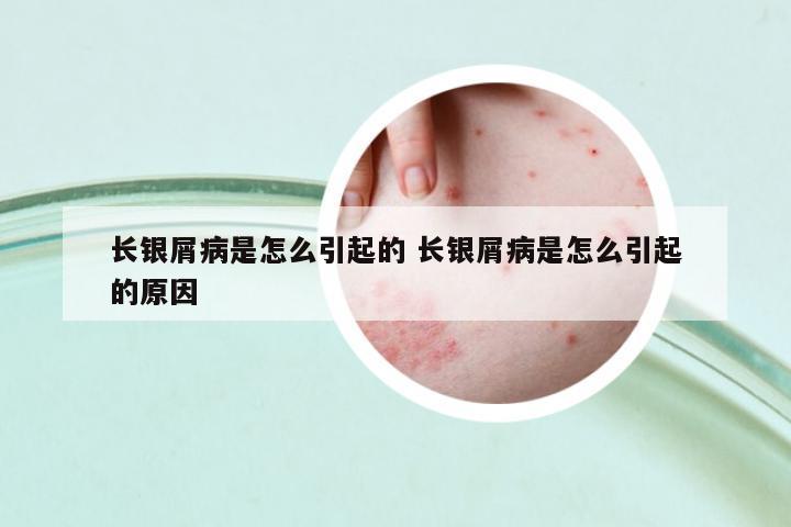 長銀屑病是怎么引起的 長銀屑病是怎么引起的原因