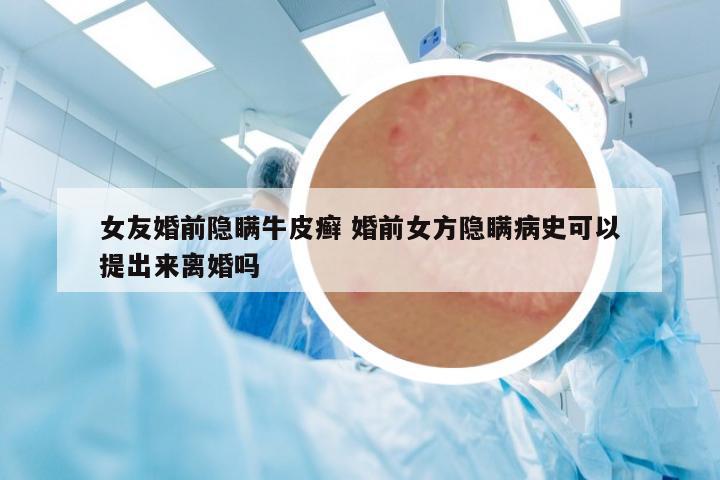 女友婚前隱瞞牛皮癬 婚前女方隱瞞病史可以提出來離婚嗎