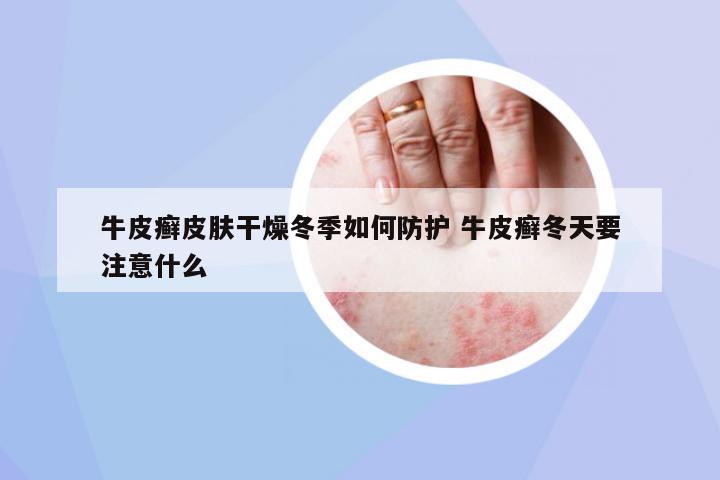 牛皮癬皮膚干燥冬季如何防護 牛皮癬冬天要注意什么