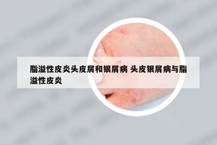 脂溢性皮炎頭皮屑和銀屑病 頭皮銀屑病與脂溢性皮炎