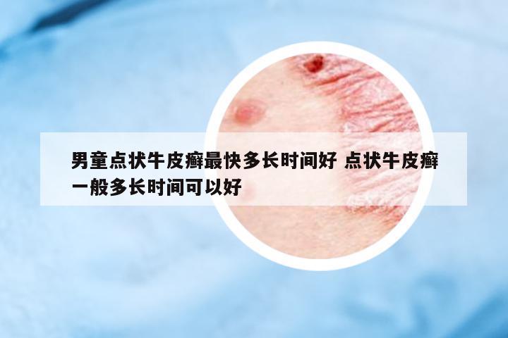 男童點狀牛皮癬最快多長時間好 點狀牛皮癬一般多長時間可以好