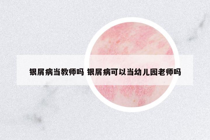 銀屑病當(dāng)教師嗎 銀屑病可以當(dāng)幼兒園老師嗎