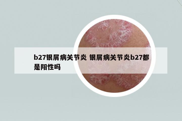 b27銀屑病關(guān)節(jié)炎 銀屑病關(guān)節(jié)炎b27都是陽性嗎