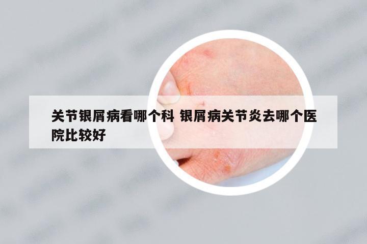 關(guān)節(jié)銀屑病看哪個科 銀屑病關(guān)節(jié)炎去哪個醫(yī)院比較好