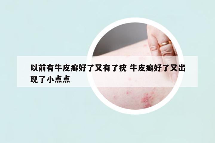 以前有牛皮癬好了又有了疣 牛皮癬好了又出現了小點點