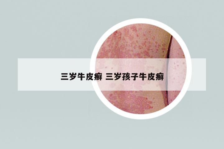 三歲牛皮癬 三歲孩子牛皮癬