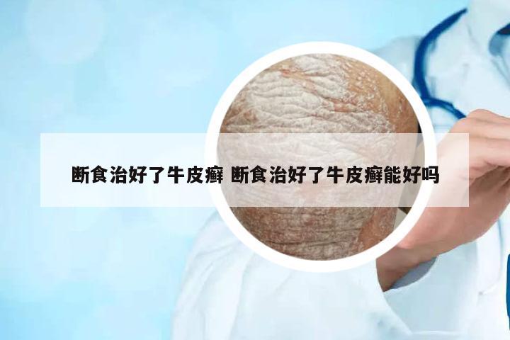 斷食治好了牛皮癬 斷食治好了牛皮癬能好嗎