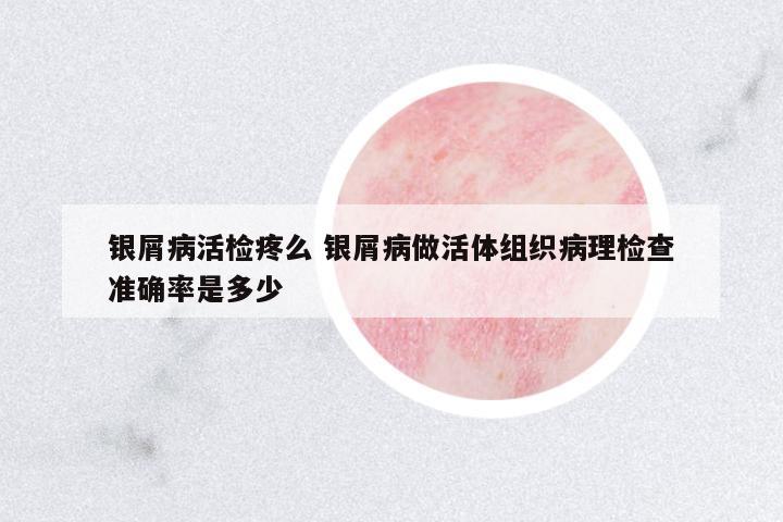 銀屑病活檢疼么 銀屑病做活體組織病理檢查準確率是多少