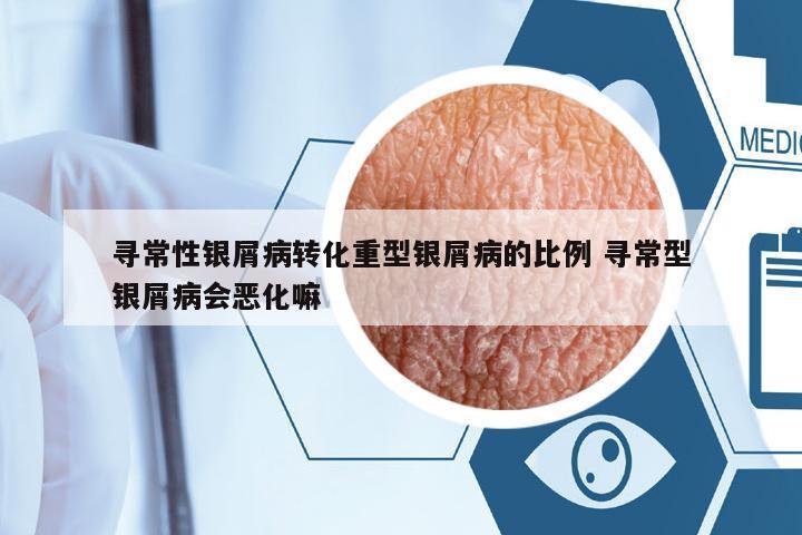 尋常性銀屑病轉(zhuǎn)化重型銀屑病的比例 尋常型銀屑病會惡化嘛