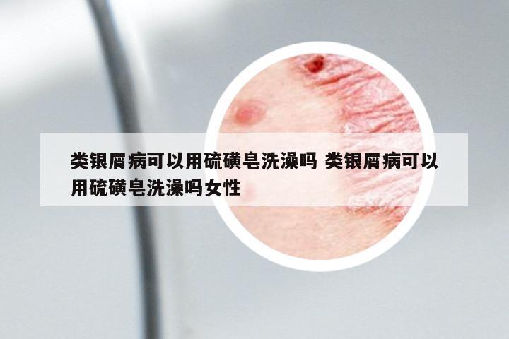 類銀屑病可以用硫磺皂洗澡嗎 類銀屑病可以用硫磺皂洗澡嗎女性