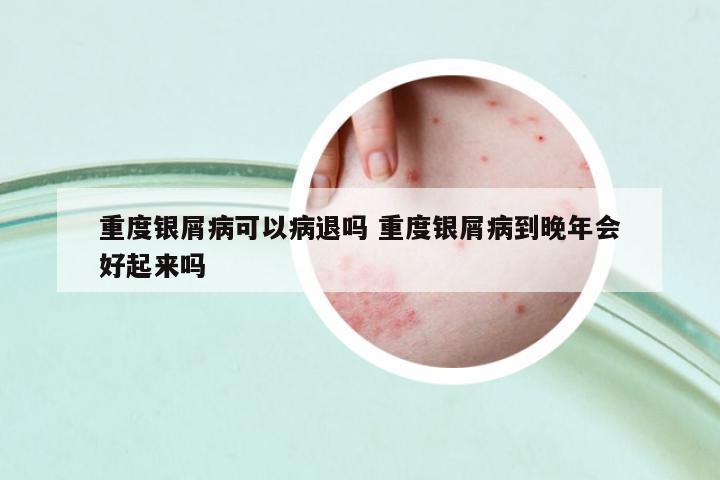 重度銀屑病可以病退嗎 重度銀屑病到晚年會(huì)好起來嗎